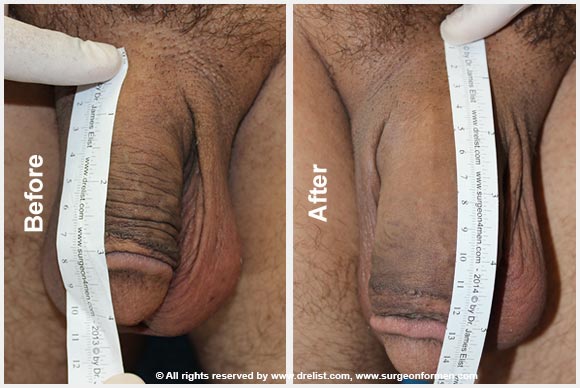 Cock Enlargement Surgery 23