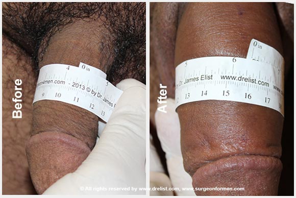 Before And After Pics Of Penis Enlargement 32