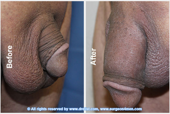 Before And After Pics Of Penis Enlargement 23