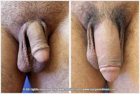 Penile extension before and after photos