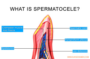 Spermatocele image