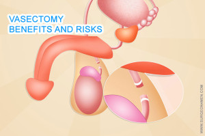 Vasectomy | Benefits and Risks