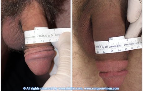 Penis extension before and after photos
