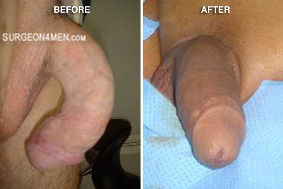 Penis procedure before and after photos