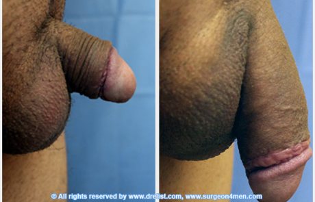 Penis extension before and after photos