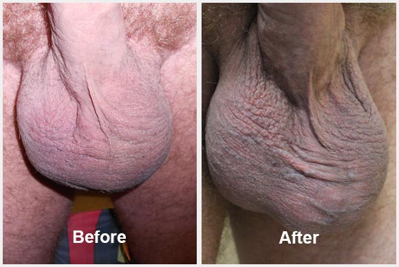 Testicular enhancement before and after photos