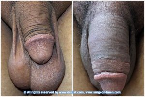 Penile extension surgery before and after photos