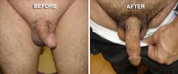 Penile procedure before and after photos