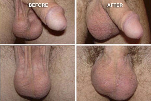 Testicular and penile enhancement before and after photos