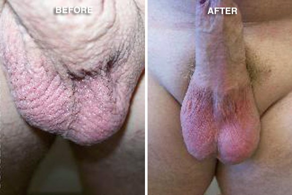 Testicular enhancement before and after photos